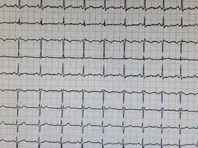 EKG-Ableitung bei einem Kind mit Elektroden auf dem Brustkorb
